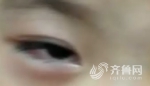 济南：4岁男童被铅笔戳伤眼睛 晶体摘除今后只能戴假体 - 东营网