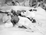 烟台24周早产女婴奇迹存活 出生时体重仅720克 - 东营网