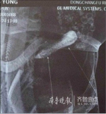 聊城：15厘米黄瓜卡在直肠 医生紧急手术取出 - 半岛网