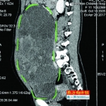 11岁少女腹部隆起如怀孕 医生摘除6斤肿瘤 - 山东华网